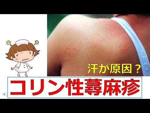 【原因不明の蕁麻疹】汗が原因？コリン性蕁麻疹とは？　＃蕁麻疹　＃運動誘発性蕁麻疹