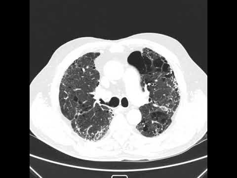 Fibrose pulmonar idiopática