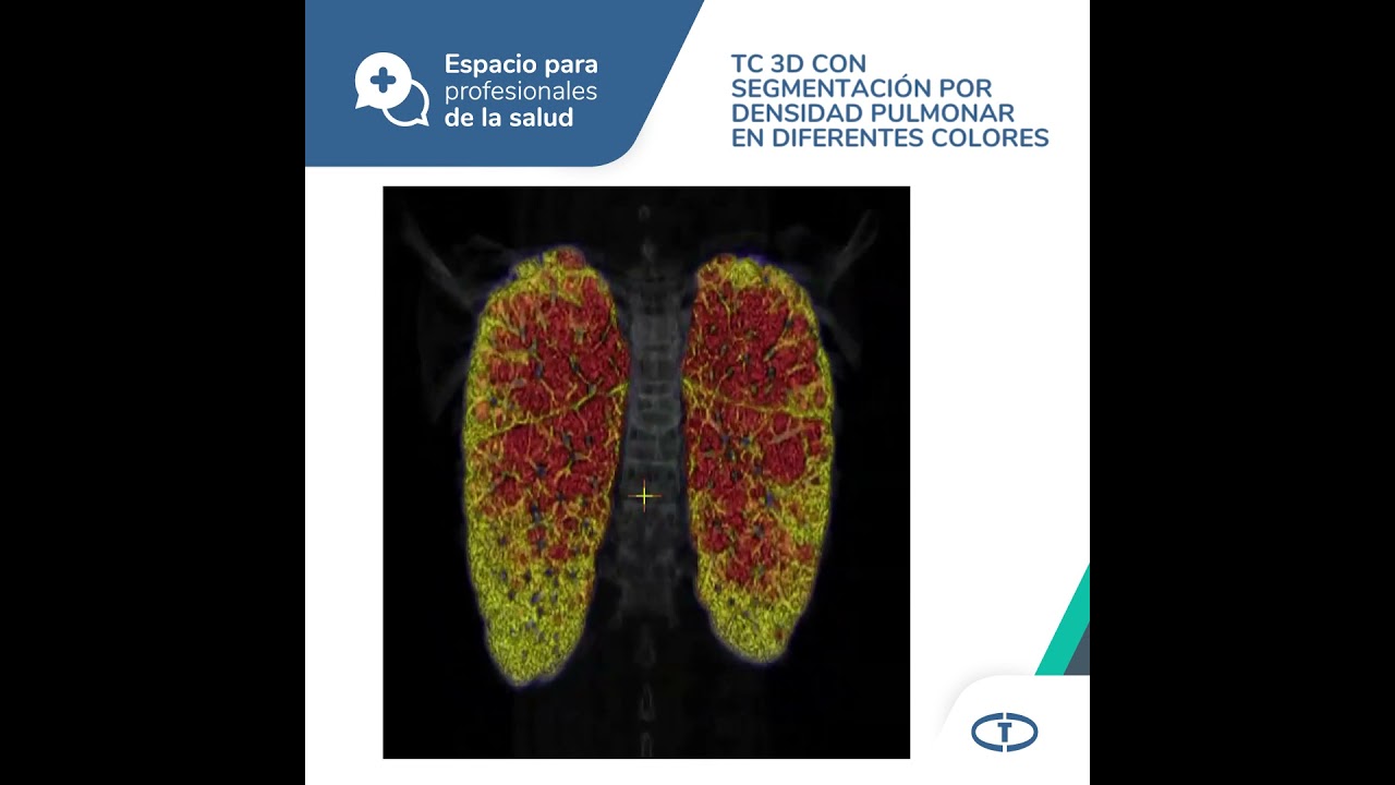 Espacio para profesionales - Cuantificación de Enfisema Pulmonar por TC