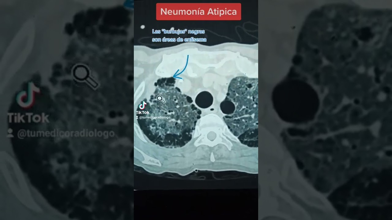 Neumonía Atipica, enfisema y bulas