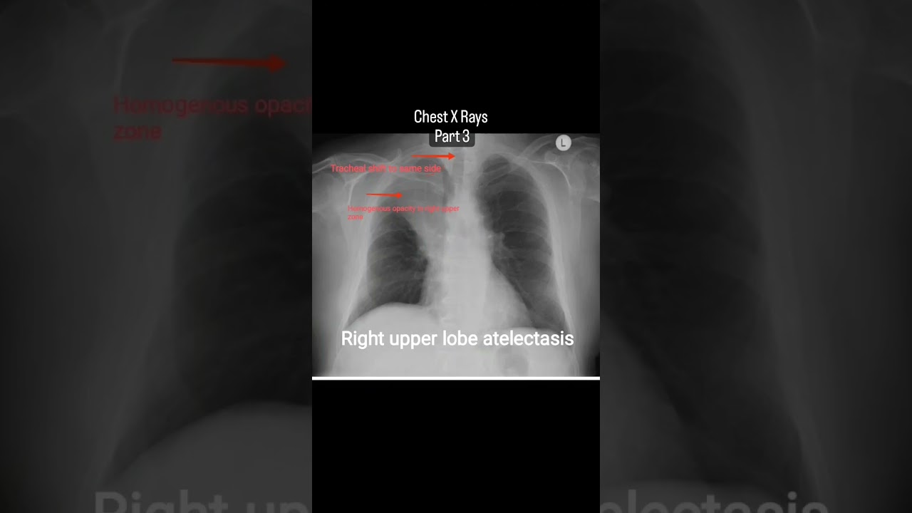 Chest X rays ( Lung collapse, atelectasis & Pulmonary fibrosis)