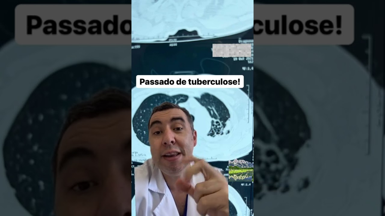 Tosse persistente! Observem esse caso e essa CAUSA para a tosse persistente! #tosse #tuberculose