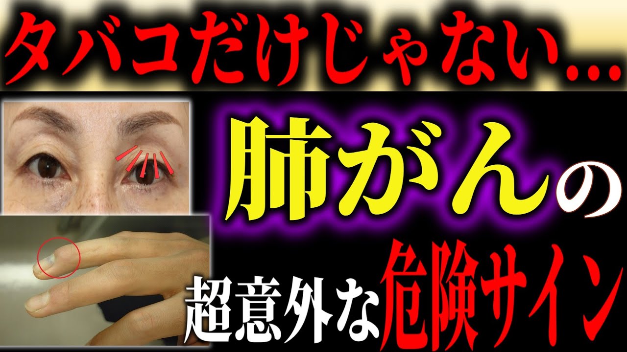 【肺がん】絶対に見逃さないで！タバコだけじゃない！意外すぎる肺がんの症状とは？【予防医学】【医学】【健康】【医療】【本の要約】【がん】