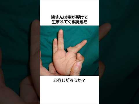 指が裂けて生まれてくる病気を知っていますか？