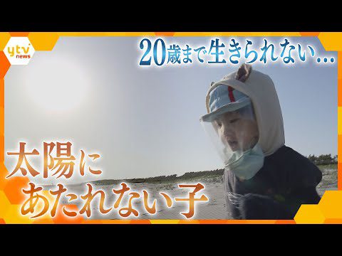 太陽の光を浴びると皮膚がんに…1歳の男の子が患った難病「色素性乾皮症」 息子の未来を探す両親の決意