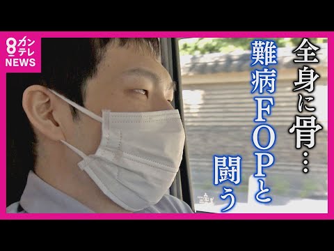 【特集】全身の筋肉が骨になる　難病「FOP」と闘い続ける青年　命を削って自らの皮膚を研究に提供　発症から15年…　全てのFOP患者が“完治する未来”を 夢見て〈カンテレNEWS〉