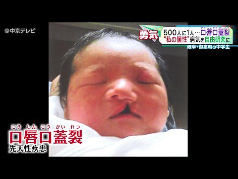 【“私の個性”病気を自由研究に】500人に１人の割合の病気「口唇口蓋裂(こうしんこうがいれつ)」　岐阜・御嵩町の中学生